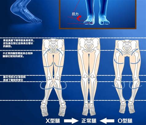 走路外八字|如何校正外八字脚